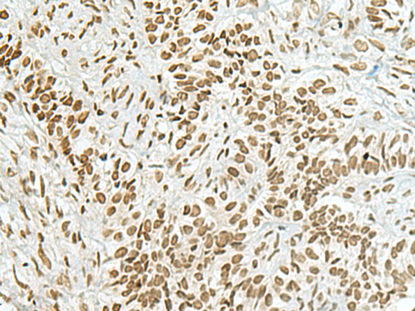 Immunohistochemistry of paraffin-embedded Human ovarian cancer tissue  using HAS1 Polyclonal Antibody at dilution of 1:70(×200)