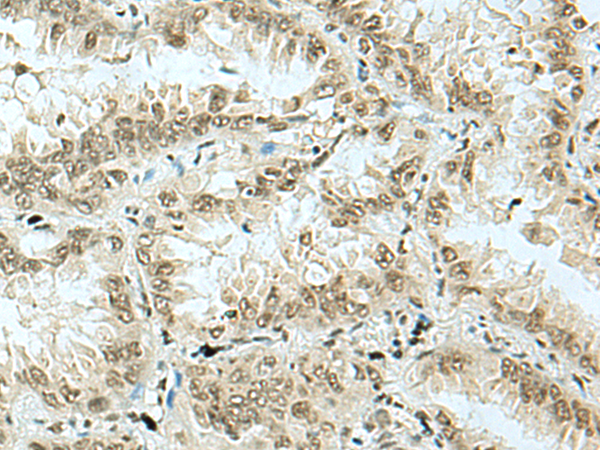 Immunohistochemistry of paraffin-embedded Human lung cancer tissue  using HAS1 Polyclonal Antibody at dilution of 1:70(×200)