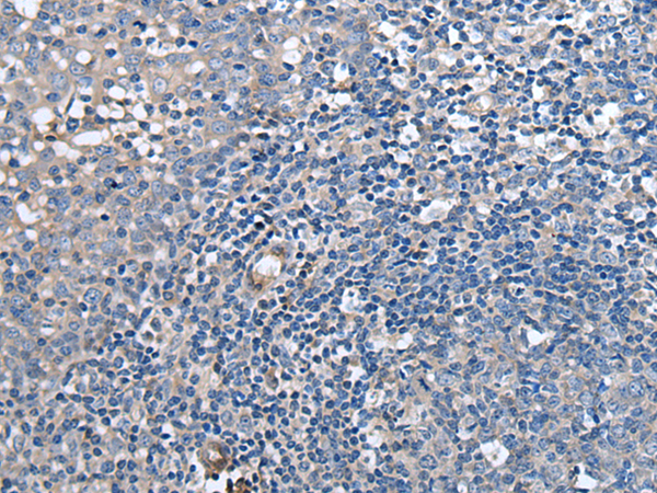 Immunohistochemistry of paraffin-embedded Human tonsil tissue  using F3 Polyclonal Antibody at dilution of 1:60(×200)