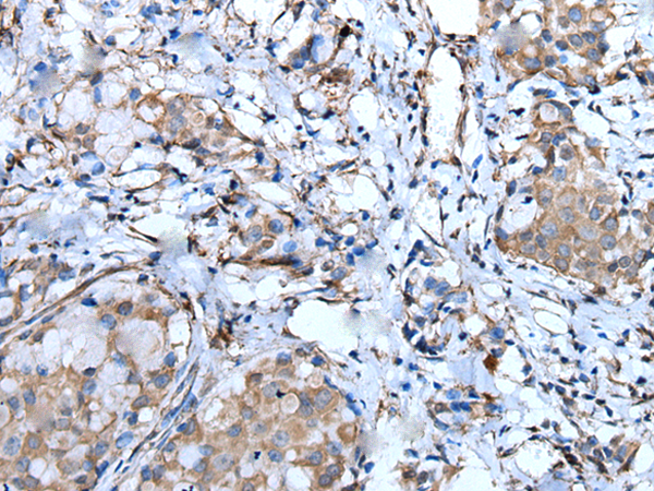 Immunohistochemistry of paraffin-embedded Human breast cancer tissue  using F3 Polyclonal Antibody at dilution of 1:60(×200)