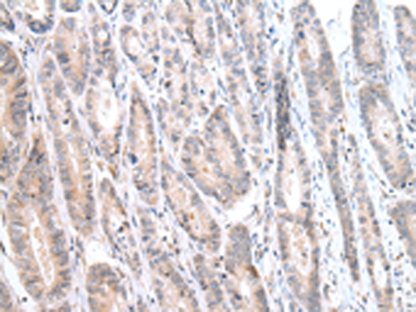 Immunohistochemistry of paraffin-embedded Human gastric cancer tissue  using CALB2 Polyclonal Antibody at dilution of 1:25(×200)