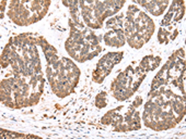 Immunohistochemistry of paraffin-embedded Human esophagus cancer tissue  using DDX58 Polyclonal Antibody at dilution of 1:35(×200)