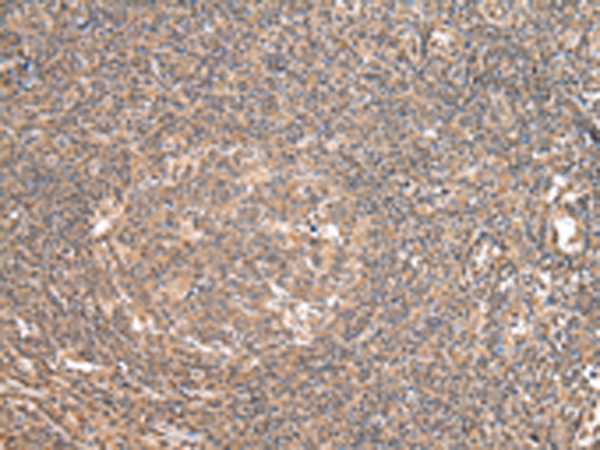 Immunohistochemistry of paraffin-embedded Human tonsil tissue  using DDX58 Polyclonal Antibody at dilution of 1:35(×200)