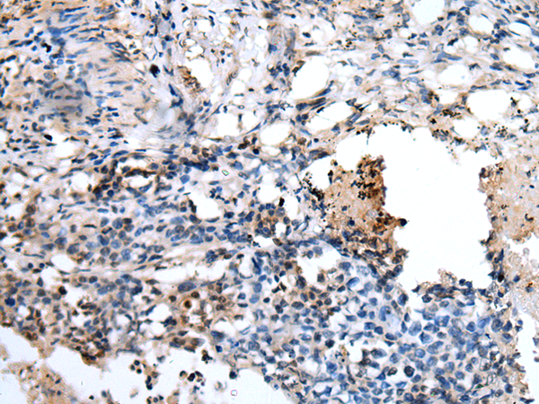 Immunohistochemistry of paraffin-embedded Human lung cancer tissue  using PPP1R15A Polyclonal Antibody at dilution of 1:45(×200)