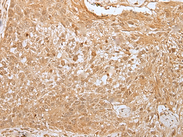Immunohistochemistry of paraffin-embedded Human lung cancer tissue  using MORF4L1 Polyclonal Antibody at dilution of 1:30(×200)