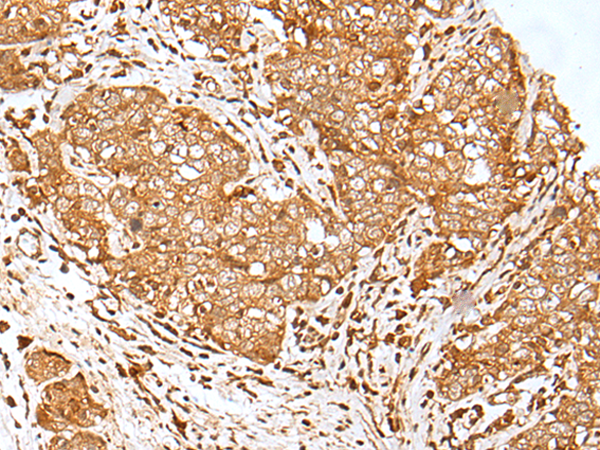 Immunohistochemistry of paraffin-embedded Human esophagus cancer tissue  using MORF4L1 Polyclonal Antibody at dilution of 1:30(×200)