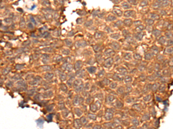 Immunohistochemistry of paraffin-embedded Human ovarian cancer tissue  using HOXD8 Polyclonal Antibody at dilution of 1:40(×200)
