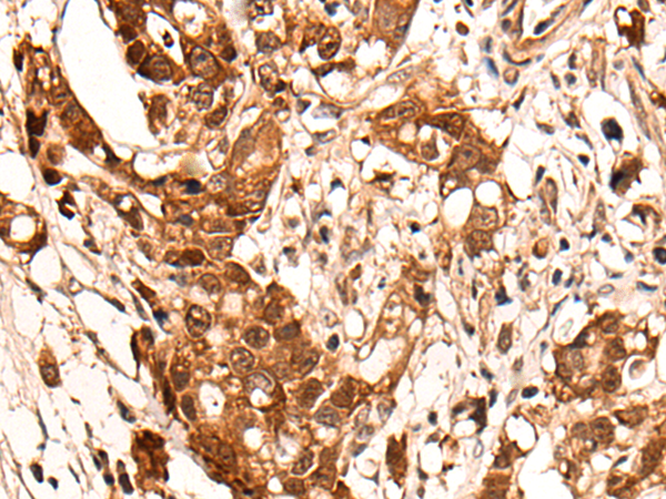 Immunohistochemistry of paraffin-embedded Human gastric cancer tissue  using HOXD8 Polyclonal Antibody at dilution of 1:40(×200)