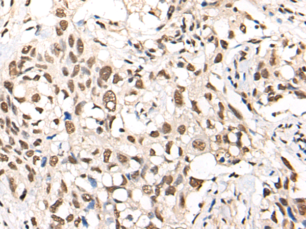 Immunohistochemistry of paraffin-embedded Human lung cancer tissue  using MTA2 Polyclonal Antibody at dilution of 1:40(×200)