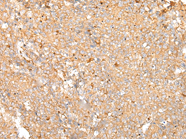 Immunohistochemistry of paraffin-embedded Human cervical cancer tissue  using PRDX4 Polyclonal Antibody at dilution of 1:25(×200)