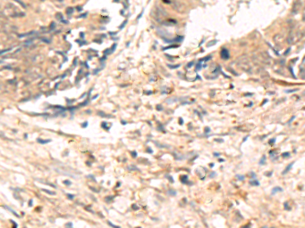 Immunohistochemistry of paraffin-embedded Human colorectal cancer tissue  using ABHD2 Polyclonal Antibody at dilution of 1:40(×200)