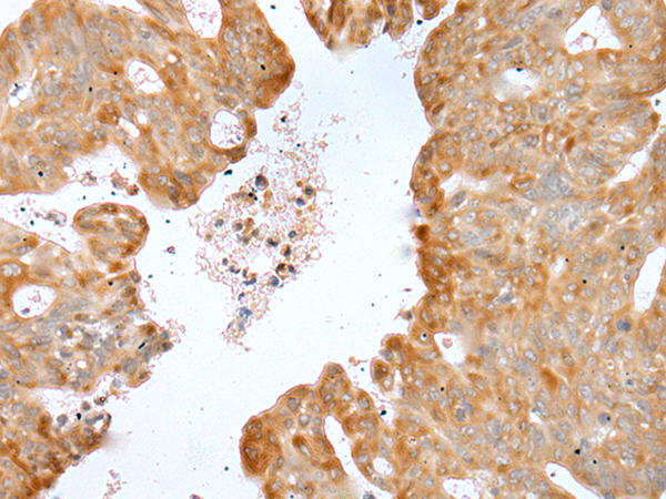 Immunohistochemistry of paraffin-embedded Human gastric cancer tissue  using P2RY4 Polyclonal Antibody at dilution of 1:40(×200)