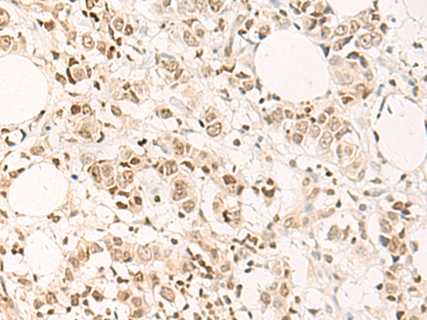 Immunohistochemistry of paraffin-embedded Human breast cancer tissue  using DPPA4 Polyclonal Antibody at dilution of 1:55(×200)