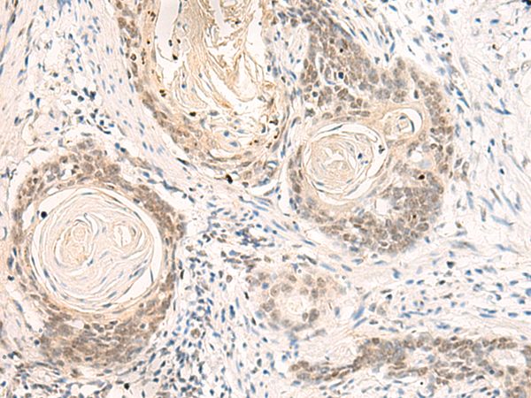 Immunohistochemistry of paraffin-embedded Human esophagus cancer tissue  using DPPA4 Polyclonal Antibody at dilution of 1:55(×200)