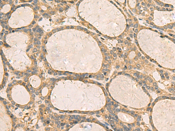 Immunohistochemistry of paraffin-embedded Human thyroid cancer tissue  using CXCL1 Polyclonal Antibody at dilution of 1:35(×200)