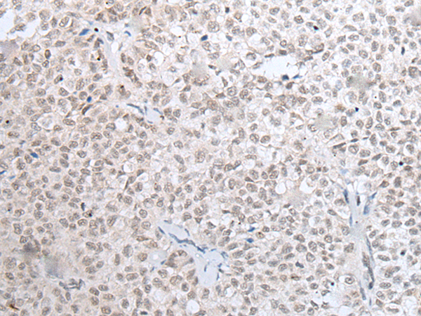 Immunohistochemistry of paraffin-embedded Human ovarian cancer tissue  using HOXC11 Polyclonal Antibody at dilution of 1:25(×200)
