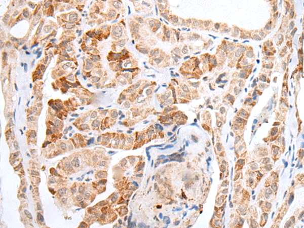 Immunohistochemistry of paraffin-embedded Human thyroid cancer tissue  using HOXC11 Polyclonal Antibody at dilution of 1:25(×200)