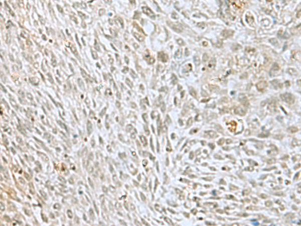 Immunohistochemistry of paraffin-embedded Human lung cancer tissue  using HOXC9 Polyclonal Antibody at dilution of 1:40(×200)