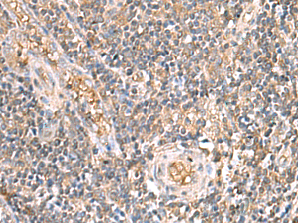 Immunohistochemistry of paraffin-embedded Human tonsil tissue  using ARF5 Polyclonal Antibody at dilution of 1:40(×200)