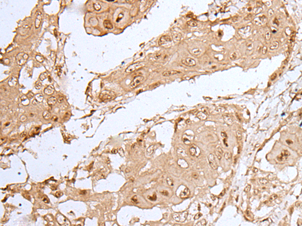 Immunohistochemistry of paraffin-embedded Human esophagus cancer tissue  using HOXC9 Polyclonal Antibody at dilution of 1:35(×200)