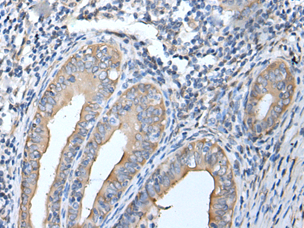 Immunohistochemistry of paraffin-embedded Human cervical cancer tissue  using HSPB1 Polyclonal Antibody at dilution of 1:25(×200)