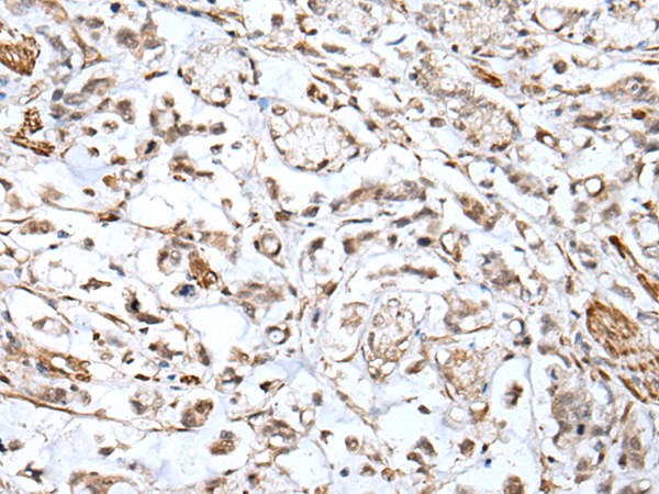 Immunohistochemistry of paraffin-embedded Human gastric cancer tissue  using HSPB1 Polyclonal Antibody at dilution of 1:25(×200)