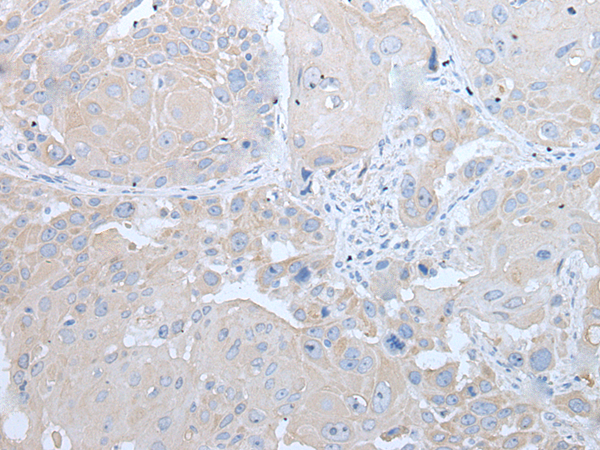 Immunohistochemistry of paraffin-embedded Human esophagus cancer tissue  using IFNB1 Polyclonal Antibody at dilution of 1:45(×200)