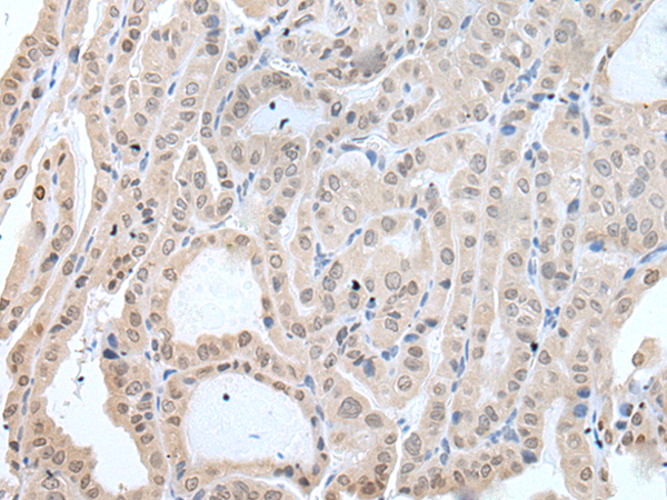 Immunohistochemistry of paraffin-embedded Human thyroid cancer tissue  using IFNB1 Polyclonal Antibody at dilution of 1:45(×200)