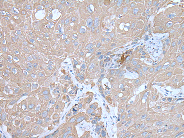 Immunohistochemistry of paraffin-embedded Human esophagus cancer tissue  using IGF2BP3 Polyclonal Antibody at dilution of 1:30(×200)