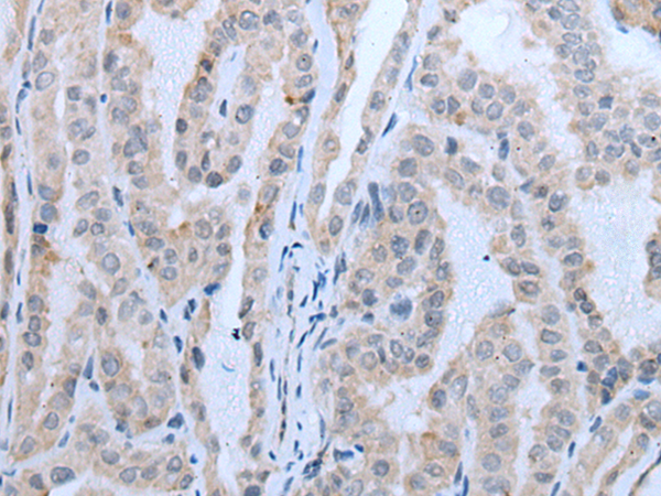 Immunohistochemistry of paraffin-embedded Human thyroid cancer tissue  using IGF2BP3 Polyclonal Antibody at dilution of 1:30(×200)