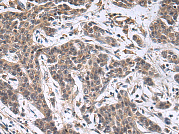 Immunohistochemistry of paraffin-embedded Human colorectal cancer tissue  using MBL2 Polyclonal Antibody at dilution of 1:25(×200)