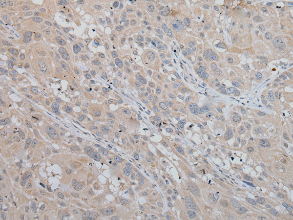 Immunohistochemistry of paraffin-embedded Human esophagus cancer tissue  using MLANA Polyclonal Antibody at dilution of 1:50(×200)
