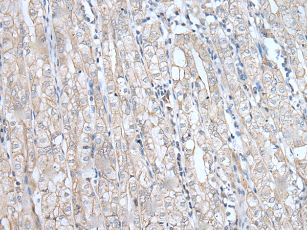 Immunohistochemistry of paraffin-embedded Human gastric cancer tissue  using SPTA1 Polyclonal Antibody at dilution of 1:80(×200)