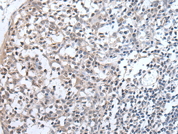 Immunohistochemistry of paraffin-embedded Human tonsil tissue  using PLAG1 Polyclonal Antibody at dilution of 1:25(×200)