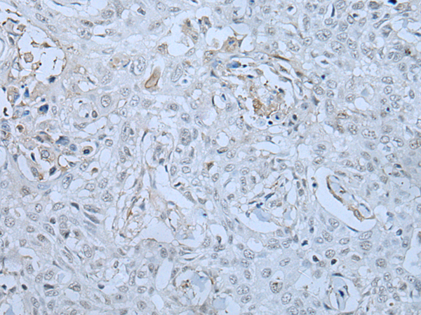 Immunohistochemistry of paraffin-embedded Human lung cancer tissue  using HUWE1 Polyclonal Antibody at dilution of 1:30(×200)