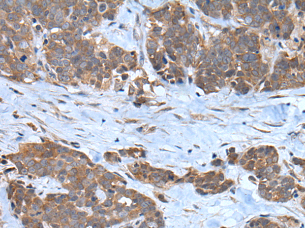 Immunohistochemistry of paraffin-embedded Human thyroid cancer tissue  using CNTN1 Polyclonal Antibody at dilution of 1:35(×200)