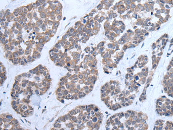 Immunohistochemistry of paraffin-embedded Human esophagus cancer tissue  using CNTN1 Polyclonal Antibody at dilution of 1:35(×200)