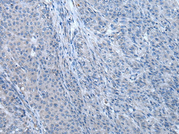 Immunohistochemistry of paraffin-embedded Human liver cancer tissue  using ZBTB3 Polyclonal Antibody at dilution of 1:55(×200)