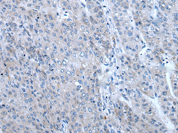 Immunohistochemistry of paraffin-embedded Human liver cancer tissue  using ZIC1 Polyclonal Antibody at dilution of 1:65(×200)