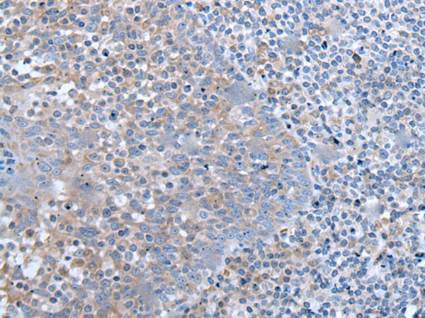 Immunohistochemistry of paraffin-embedded Human tonsil tissue  using ZIC1 Polyclonal Antibody at dilution of 1:65(×200)