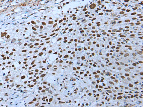 Immunohistochemistry of paraffin-embedded Human lung cancer tissue  using ZNHIT3 Polyclonal Antibody at dilution of 1:80(×200)