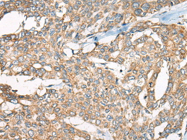 Immunohistochemistry of paraffin-embedded Human liver cancer tissue  using YEATS2 Polyclonal Antibody at dilution of 1:55(×200)