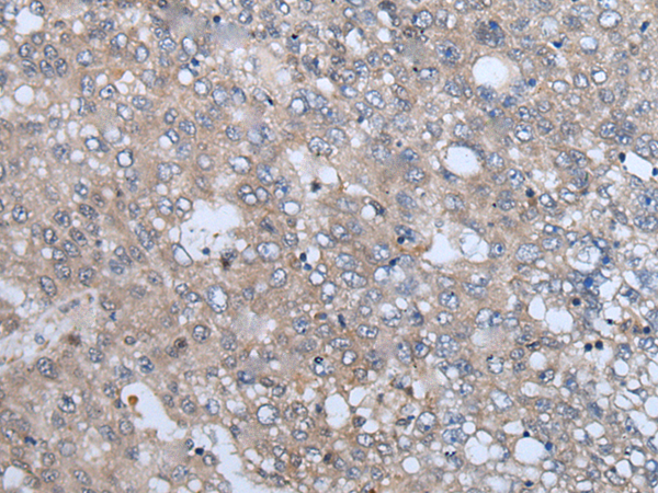 Immunohistochemistry of paraffin-embedded Human liver cancer tissue  using VAMP4 Polyclonal Antibody at dilution of 1:50(×200)