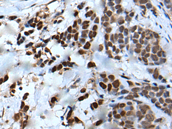 Immunohistochemistry of paraffin-embedded Human thyroid cancer tissue  using VEZT Polyclonal Antibody at dilution of 1:50(×200)