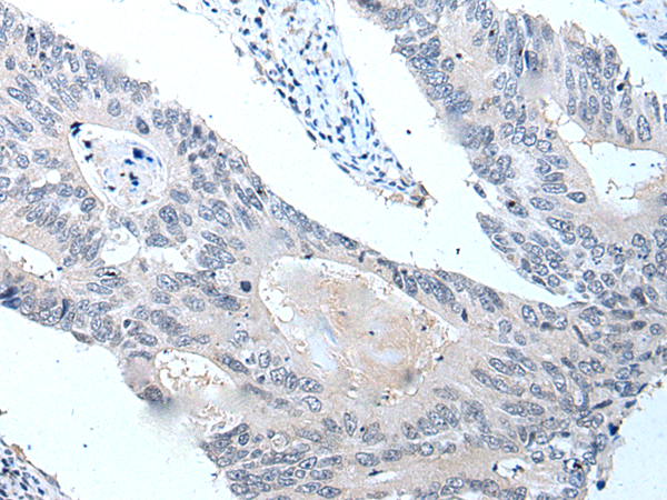 Immunohistochemistry of paraffin-embedded Human colorectal cancer tissue  using VPS35 Polyclonal Antibody at dilution of 1:25(×200)