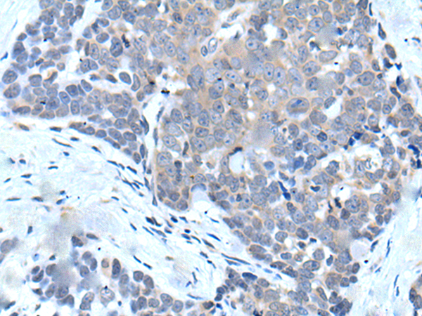Immunohistochemistry of paraffin-embedded Human thyroid cancer tissue  using VPS35 Polyclonal Antibody at dilution of 1:25(×200)