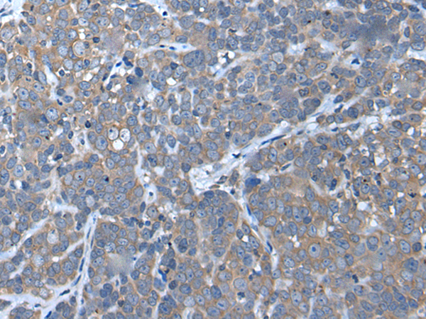 Immunohistochemistry of paraffin-embedded Human thyroid cancer tissue  using UBAC2 Polyclonal Antibody at dilution of 1:50(×200)