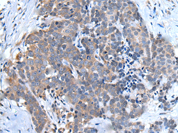 Immunohistochemistry of paraffin-embedded Human thyroid cancer tissue  using UBQLN2 Polyclonal Antibody at dilution of 1:45(×200)