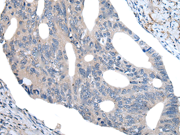 Immunohistochemistry of paraffin-embedded Human colorectal cancer tissue  using UBR4 Polyclonal Antibody at dilution of 1:55(×200)