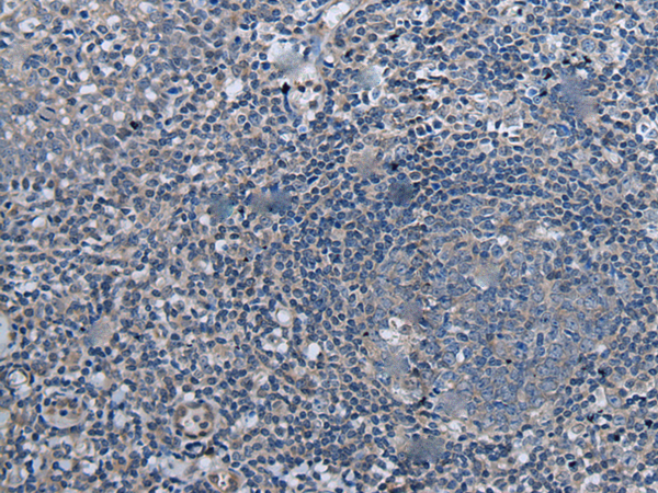 Immunohistochemistry of paraffin-embedded Human tonsil tissue  using UBR4 Polyclonal Antibody at dilution of 1:55(×200)